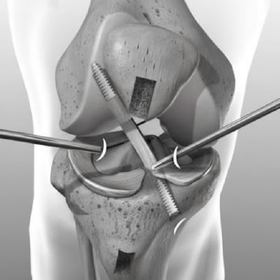 Plastia de Ligamento Cruzado Anterior Artroscópica